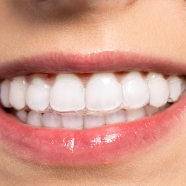 Invisalign - Quase invisíveis
